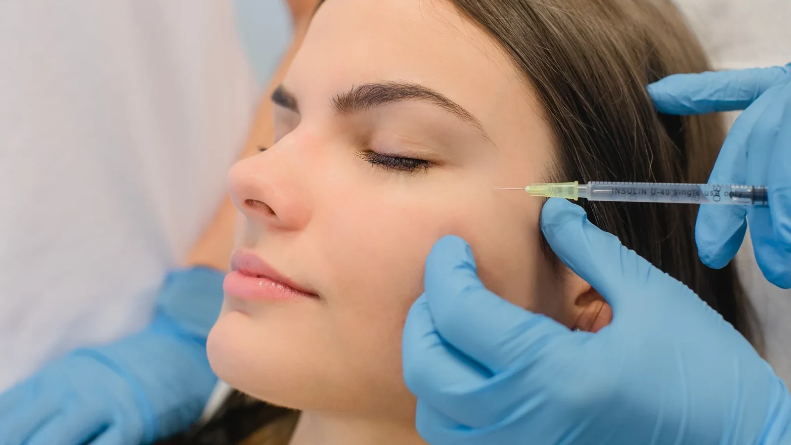 Botulinumtoxin Behandlung im Bereich der Krähenfüße in Hannover
