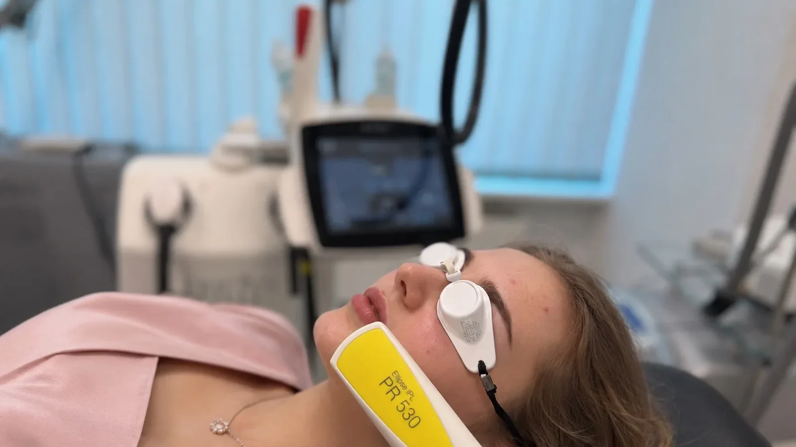 Aknebehandlung mit IPL in Hannover