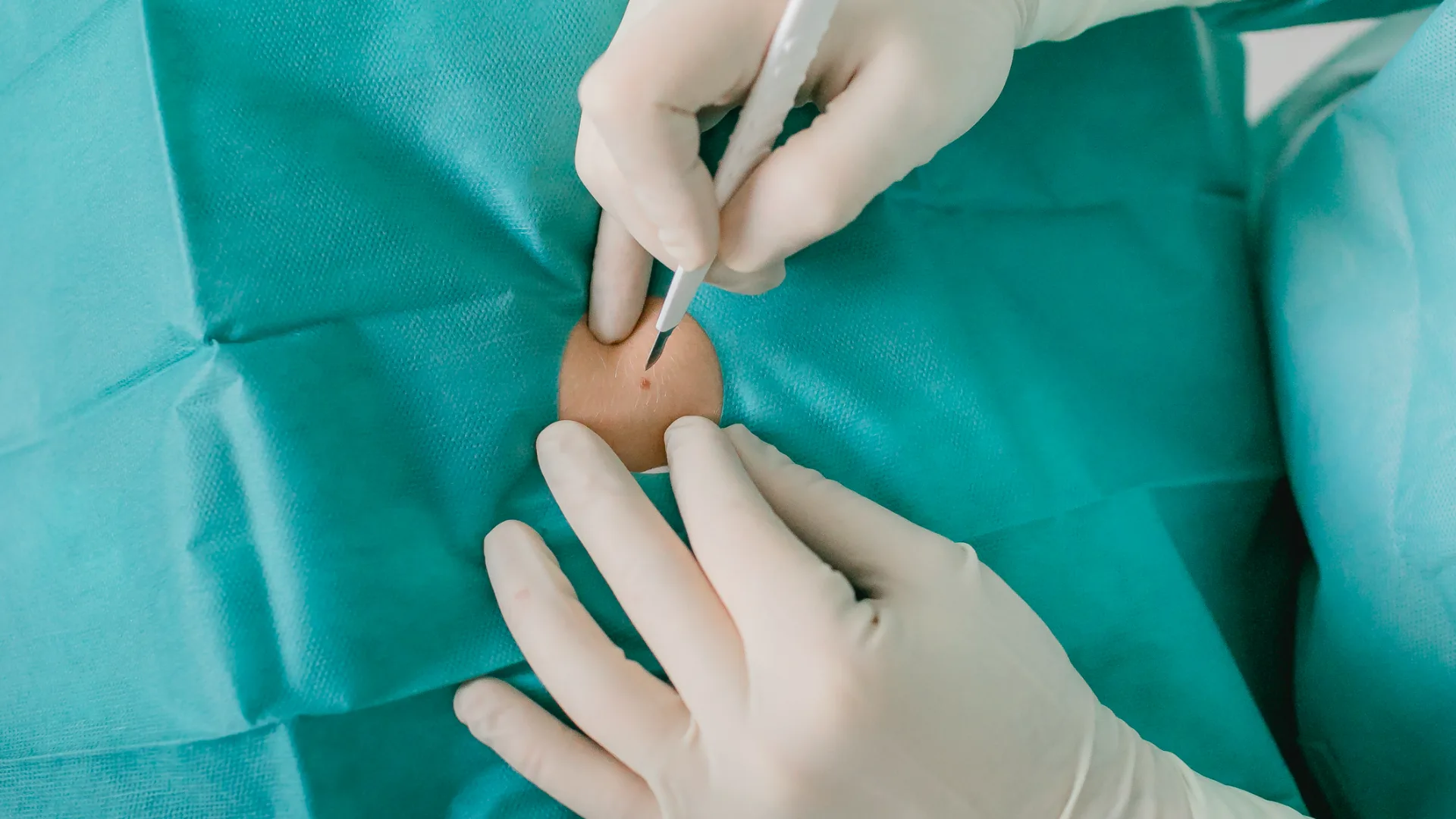 Dermatochirurgische Entfernung einer Hautveränderung in Hannover